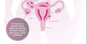 Women’s Health Spotlight: Get in the Know about Endometriosis